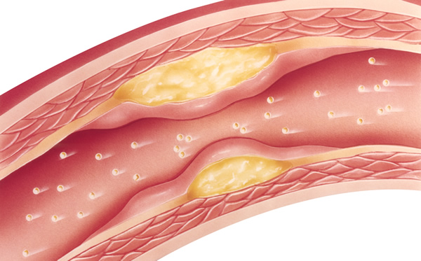 Arteriosklerose aufgrund zu hoher Cholesterinwerte