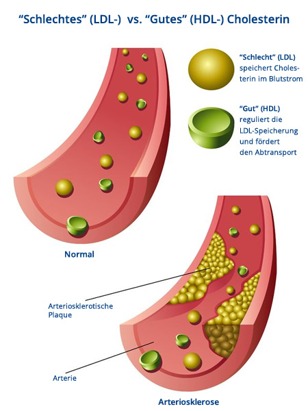 Gutes (HDL) und Schlechtes (LDL) Cholesterin